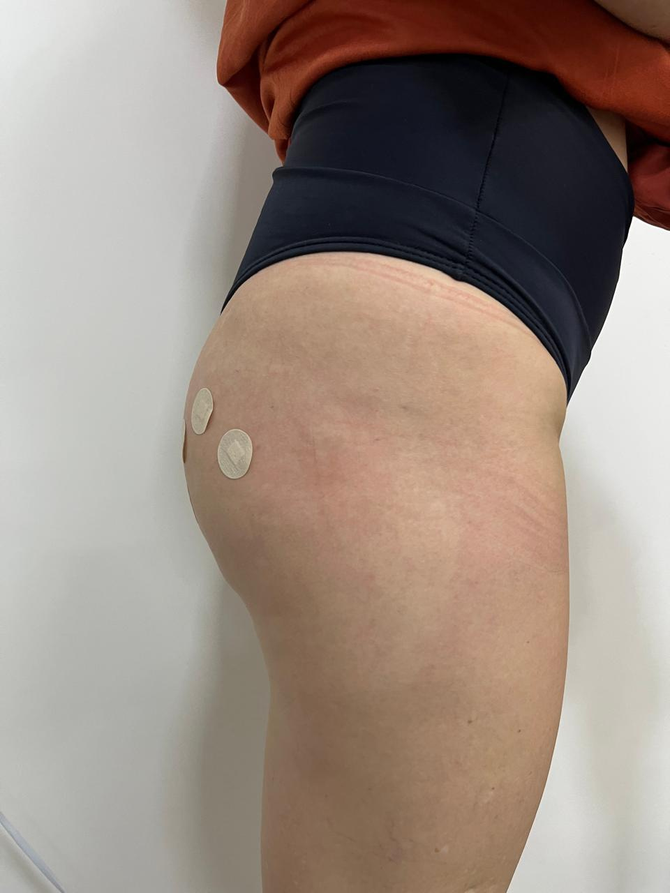 Registro corporal para avaliação estética de glúteos
