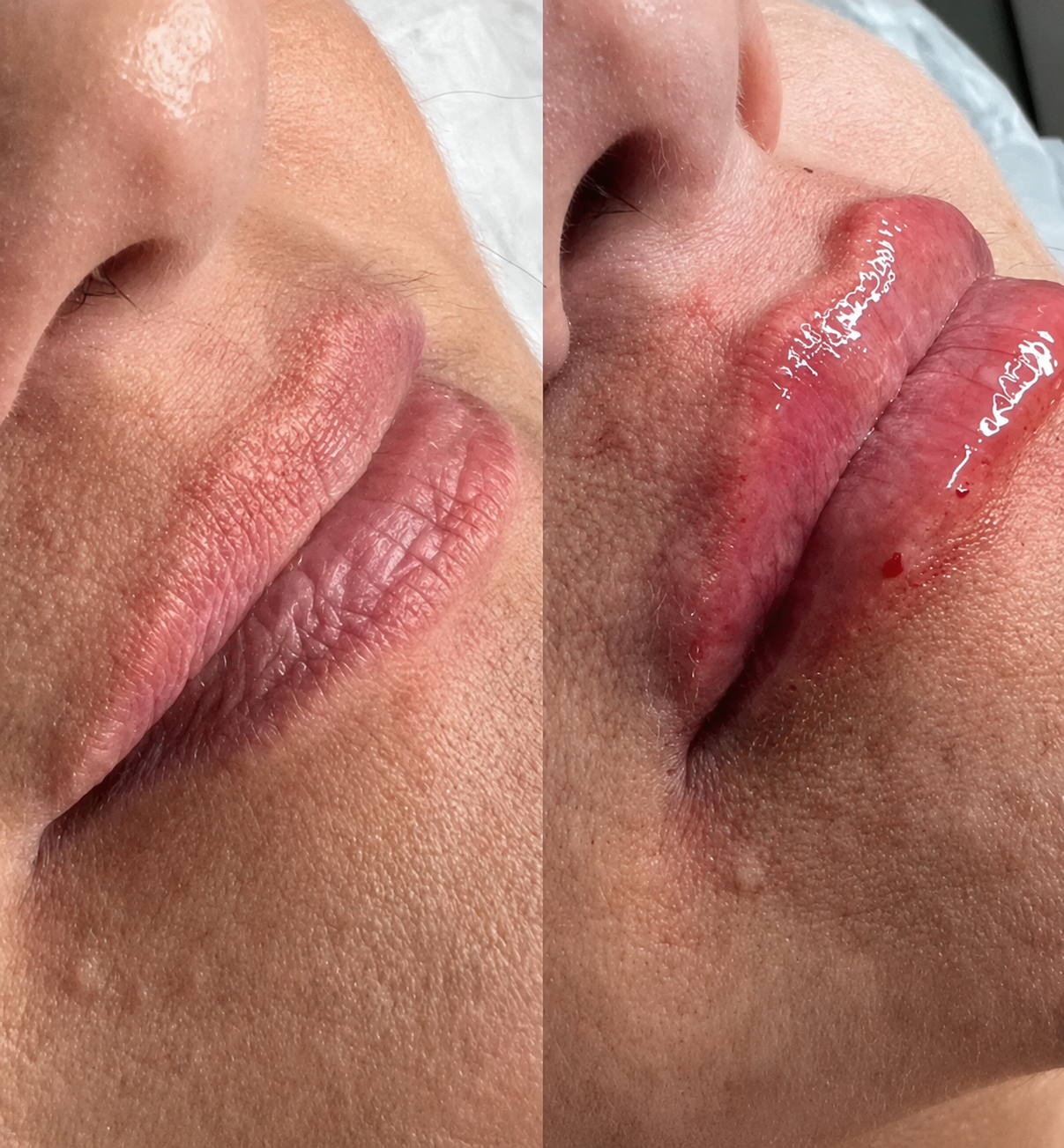 Registro real de preenchimento labial com contorno e hidratação