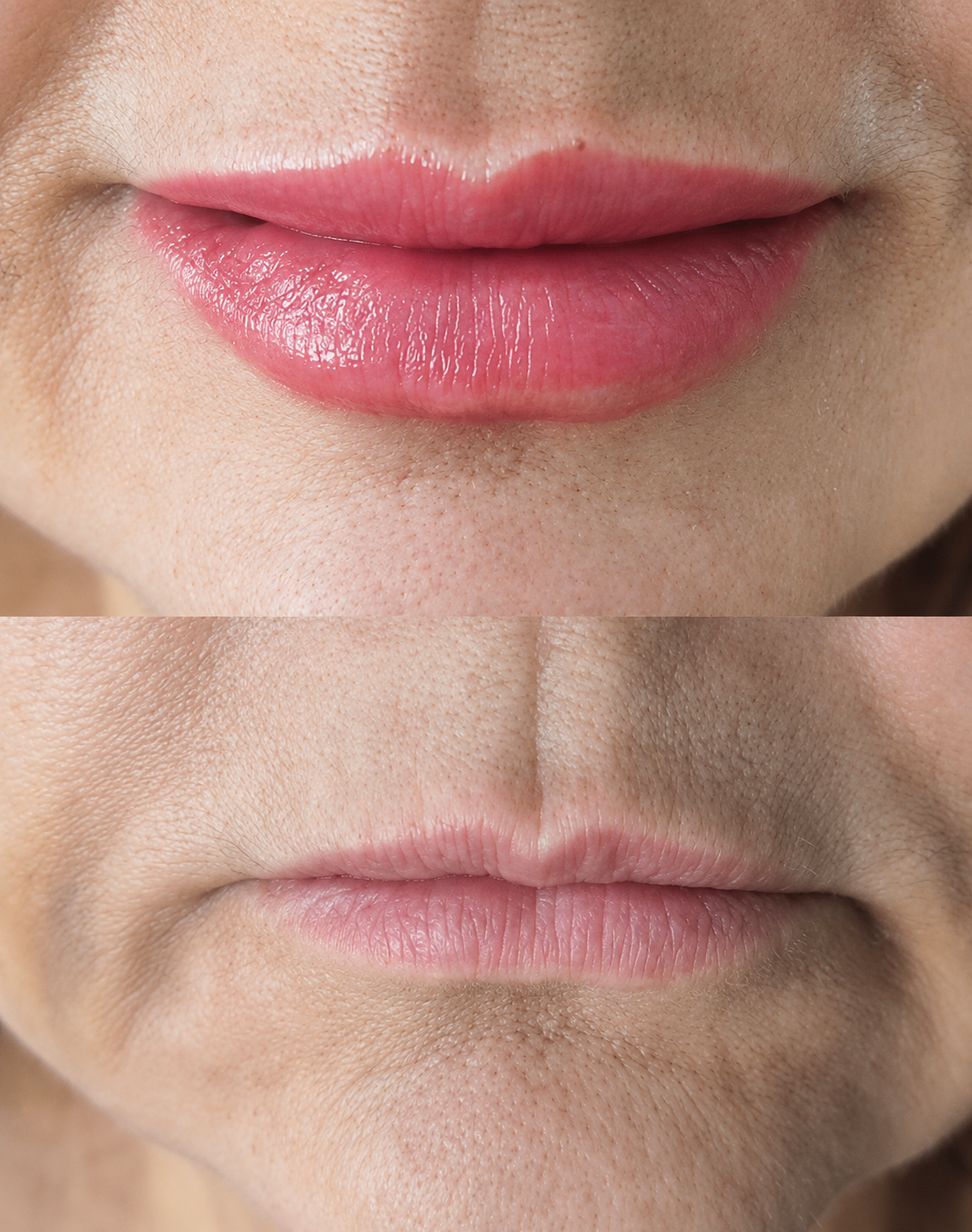 Registro real de preenchimento labial com proporção natural