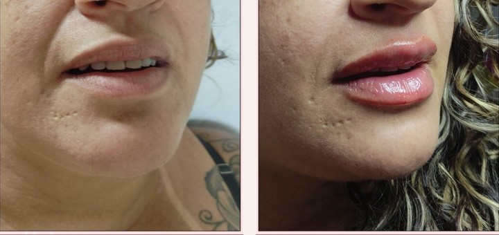 Comparativo real de preenchimento labial com volume equilibrado